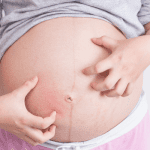 What is Cholestasis of Pregnancy?