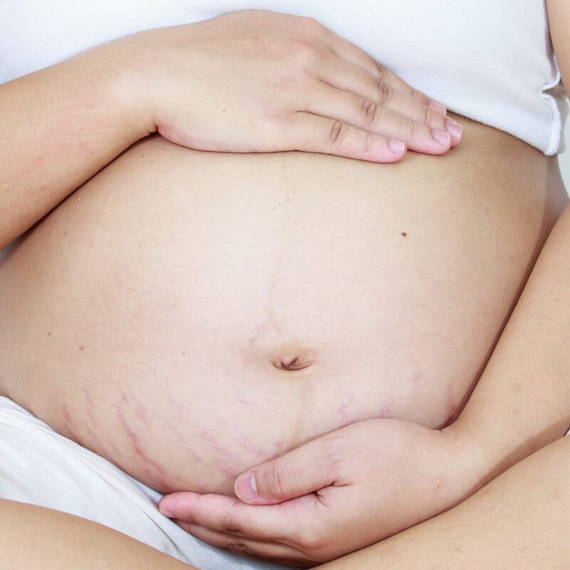 How to Treat Pregnancy Stretch Marks with Simple Steps & Safe Products